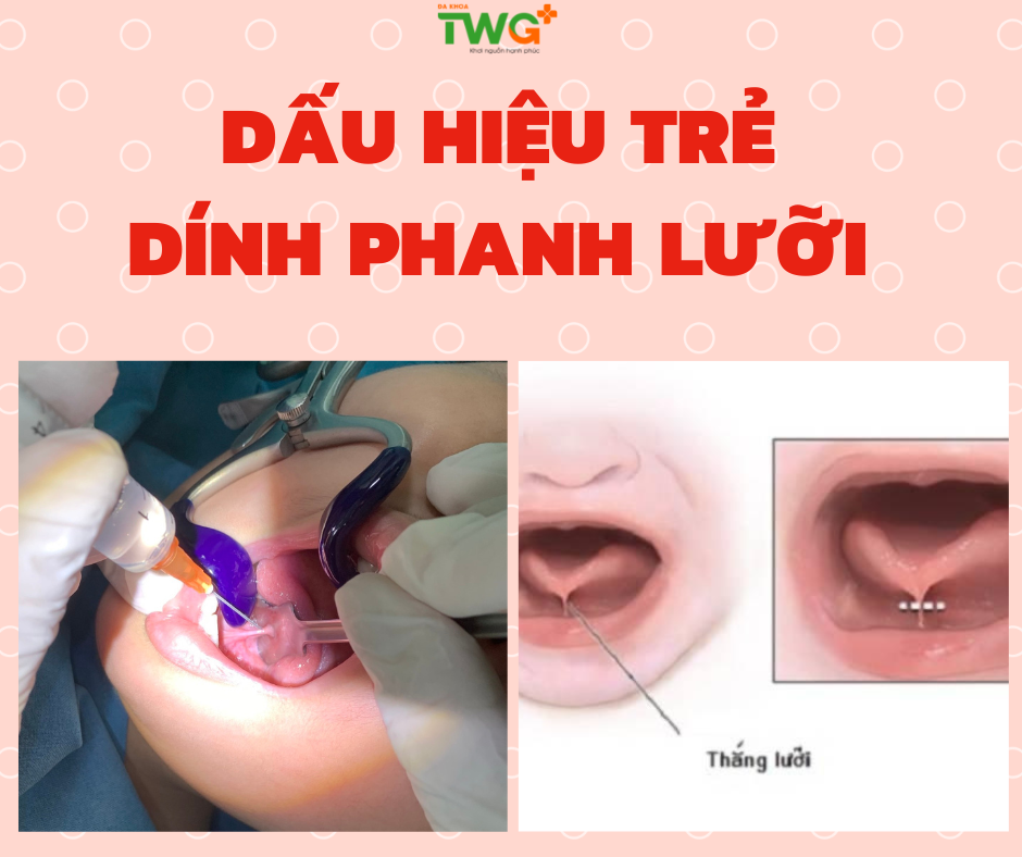 DẤU HIỆU TRẺ DÍNH PHANH LƯỠI