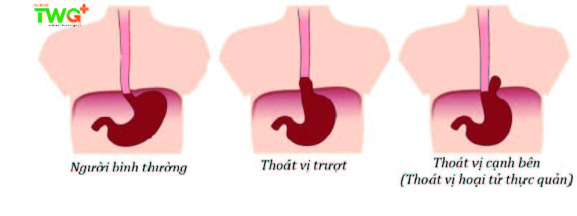 Thoát vị hoành, có nguy hiểm không?